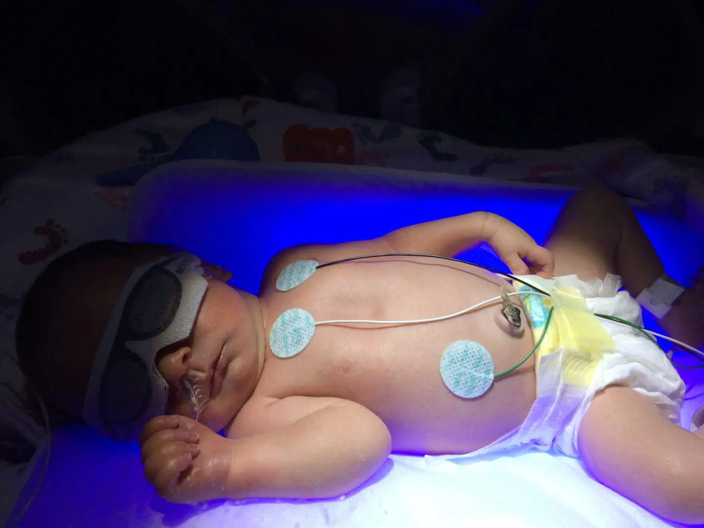 Olivia under the billi lights in the NICU
